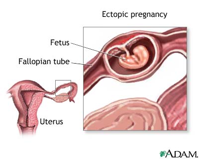‏الحمل خارج الرحم