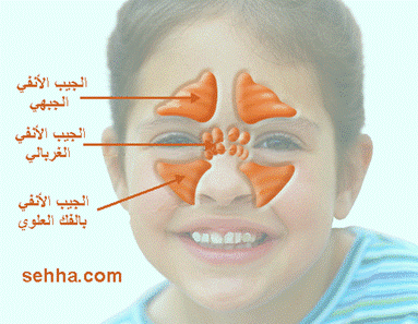 التهاب الجيوب الأنفية عند الأطفال