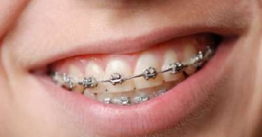 ما هى أهمية تقويم الأسنان؟